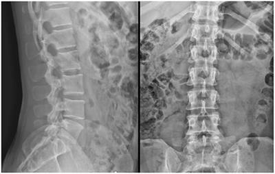 Does Virtual Reality Feedback at Infra-Low Frequency Improve Centralized Pain With Comorbid Insomnia While Mitigating Risks for Sedative Use Disorder?: A Case Report